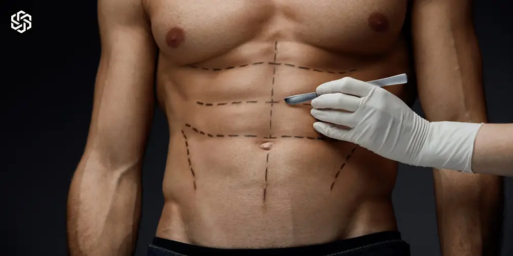 Provider marking abdomen for non-surgical body contouring treatment areas in Lake Forest IL.