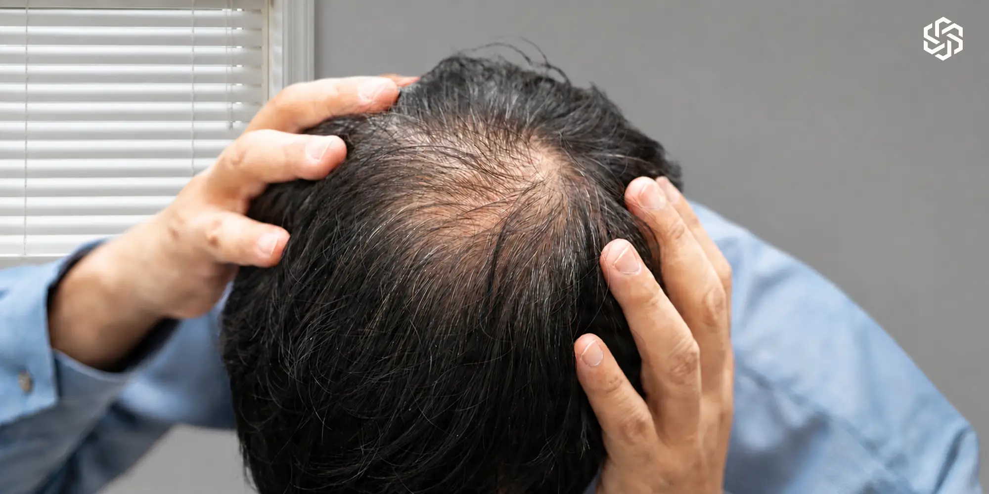 Man parting his hair to show thinning at the crown